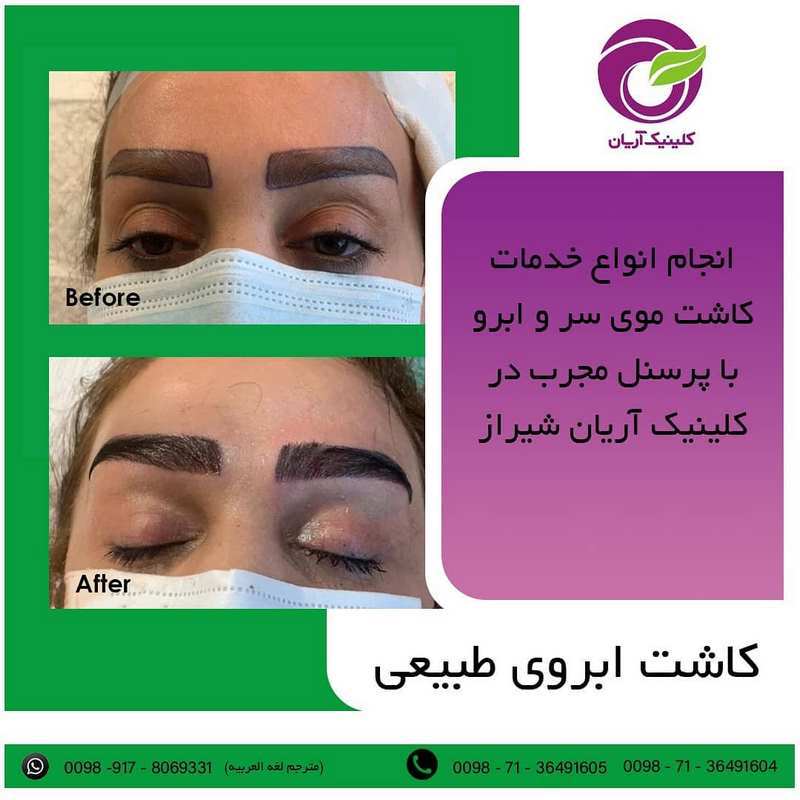 گالری فیلم کاشت ابرو